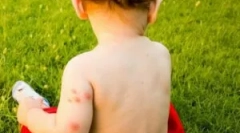 Kaj storiti, če otroški bit insekti?